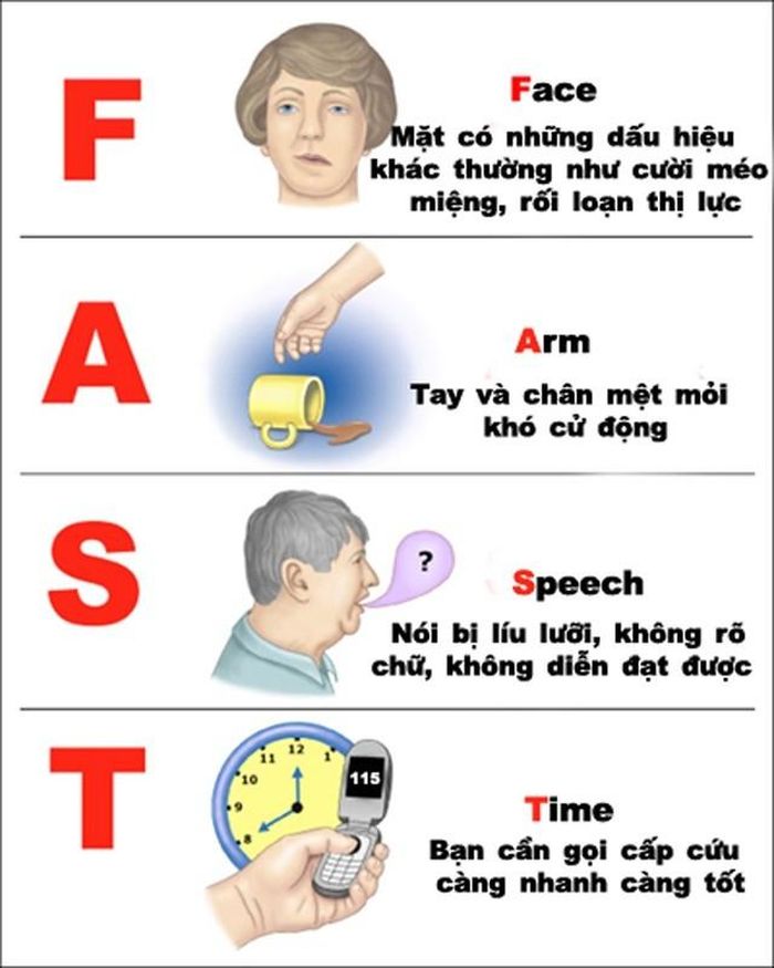 Những dấu hiệu đột quỵ. Ảnh: Trung tâm Đột quỵ - Bệnh viện Bạch Mai ↵