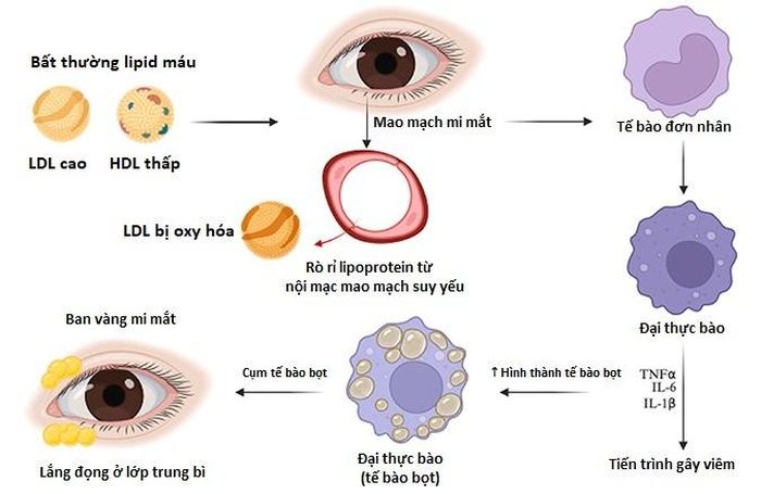  Mảng vàng do xanthelasma hình thành có chứa cholesterol và nhiều loại chất béo khác. Đồ họa: Atherosclerosis. 