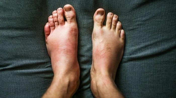  Phù nề ở mí mắt, mắt cá chân hoặc cẳng chân sau một đêm ngủ là triệu chứng khá điển hình của bệnh thận. Ảnh: Pexels. 
