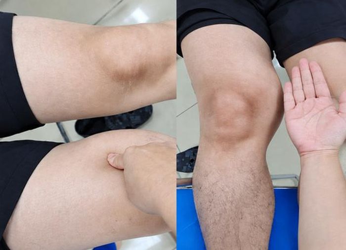 Hình ảnh khối bất thường vùng đùi phải qua thăm khám lâm sàng. Ảnh: BVCC