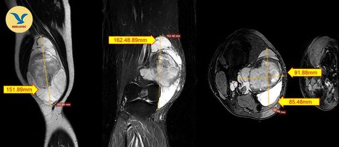 Hình ảnh MRI chụp khối bất thường tại vùng đùi phải. Ảnh: BVCC
