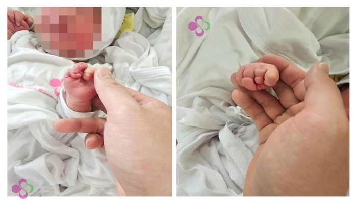 Vòng da thắt tại ngón III, IV ở bàn tay 2 bên của trẻ. Ảnh: BVCC