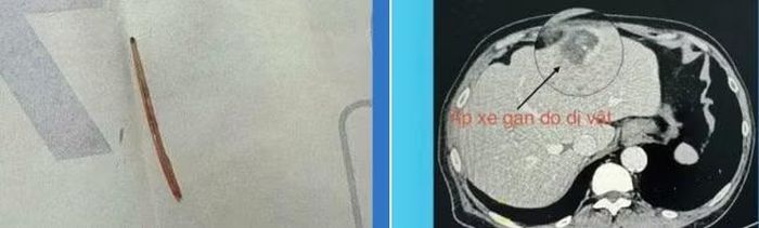 Xương cá gây ổ áp xe gan được lấy ra - Ảnh BVCC