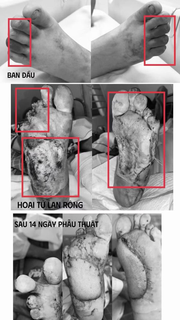 Tổn thương bàn chân sau điều trị - Ảnh BVCC