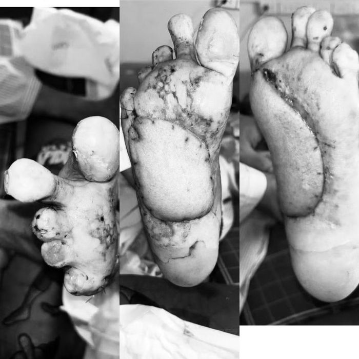 Một bàn chân bị mất 3 ngón. Một số vị trí khuyết sâu làm lộ gân và các cấu trúc bên dưới. - Ảnh BVCC