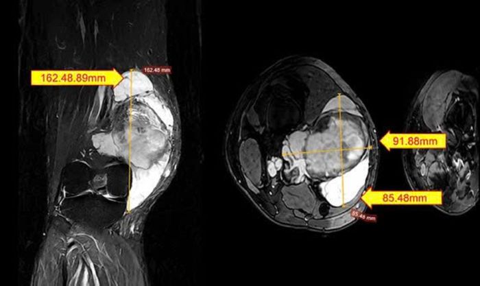 Hình ảnh MRI chụp khối bất thường tại vùng đùi phải của bệnh nhân.