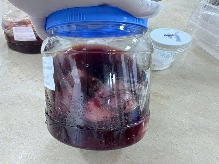 Hình ảnh khối u sau phẫu thuật.