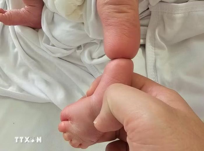 Vòng da thắt nghẹt ở cẳng chân trái của trẻ trước khi phẫu thuật. (Ảnh: TTXVN phát)