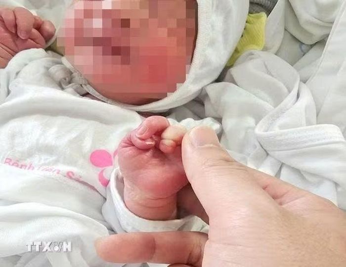 Vòng da thắt tại ngón III, IV ở bàn tay 2 bên của trẻ. (Ảnh: TTXVN phát)