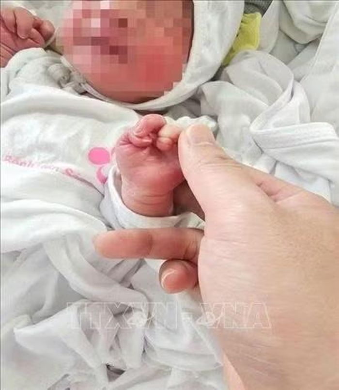 Vòng da thắt tại ngón III, IV ở bàn tay 2 bên của trẻ. Ảnh: TTXVN phát