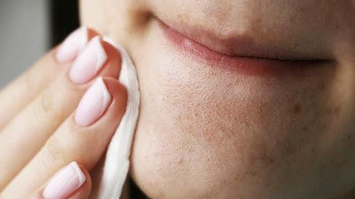 Để hạn chế tình trạng mụn đầu đen, sau khi ra ngoài về bạn hãy tẩy trang kỹ càng và rửa mặt sạch sẽ. Ảnh minh họa