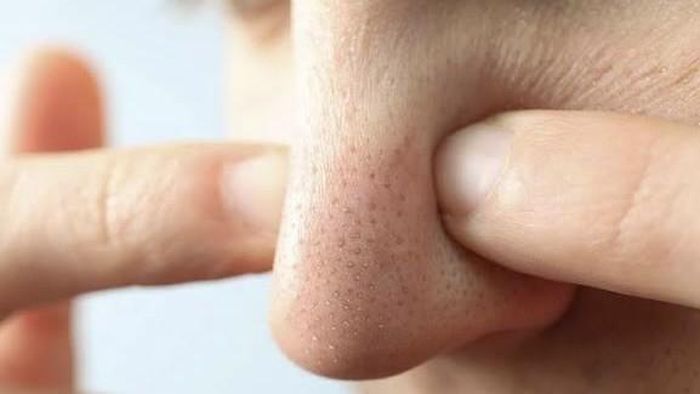 Dùng tay nặn mụn, chà xát quá mạnh lên da là những nguyên nhân khiến mụn đầu đen xuất hiện ngày càng nhiều. Ảnh minh họa