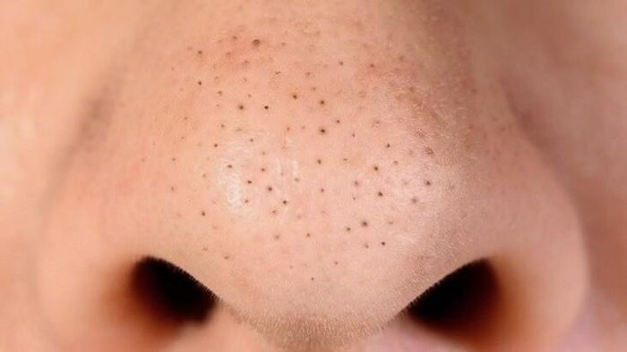 Ít ai biết rằng những thói quen tưởng trừng như vô hại lại là nguyên nhân dẫn tới tình trạng mụn đầu đen. Ảnh minh họa