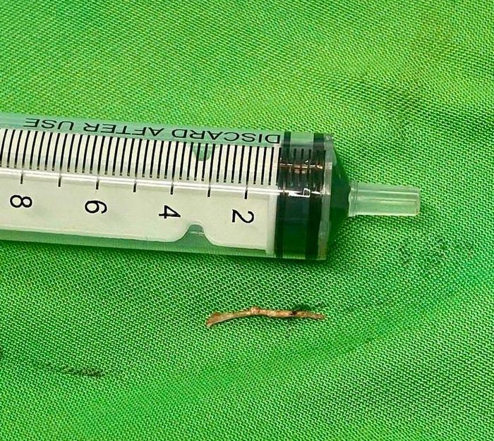 Dị vật là mảnh xương cá nằm sâu trong vùng dưới hàm trái của bệnh nhân khoảng 5 tháng. Ảnh: BVĐKBQT.