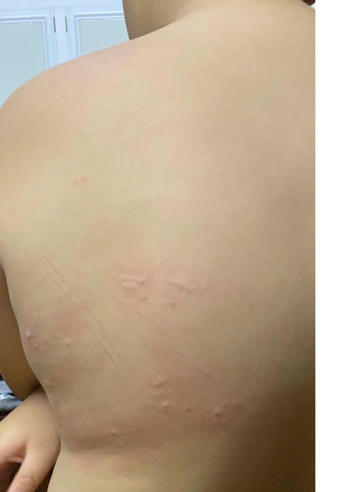  Phụ huynh cung cấp hình ảnh con có dấu hiệu bị nổi mẩn đỏ sau bữa ăn bán trú tại trường 