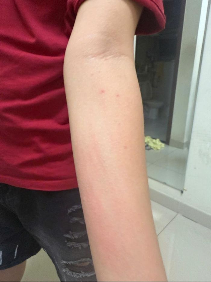  Một số học sinh sau bữa ăn xuất hiện triệu chứng dị ứng, nổi mẩn đỏ khắp người. 