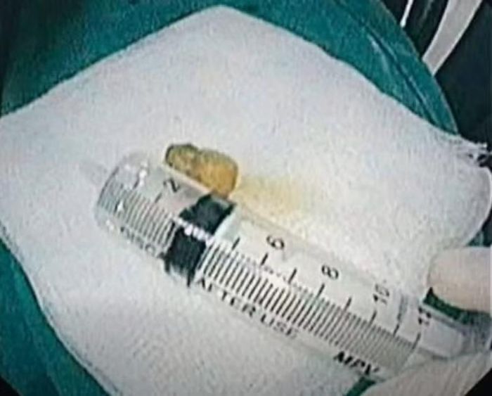 Mảnh dị vật được lấy ra - Ảnh BVCC