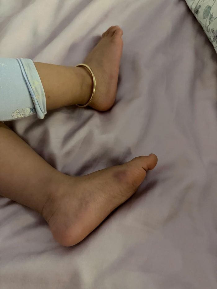Hai chân cháu K. có biểu hiện đau, sưng. Ảnh Gia đình cung cấp