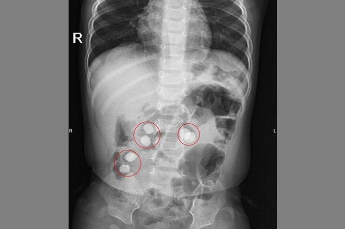 6 dị vật hình tròn (được cho là sỏi) được tìm thấy trong đường tiêu hoá của trẻ. Ảnh: BVCC