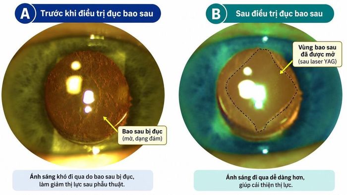 Hình ảnh trước và sau khi điều trị đục bao sau