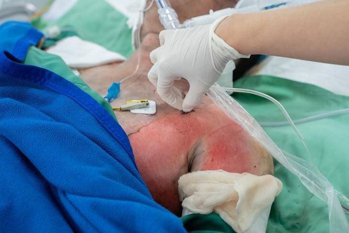 Bệnh nhân đang được điều trị tại khoa Hồi sức tích cực (ICU) khu B, Bệnh viện Chợ Rẫy. Ảnh: BVCC.