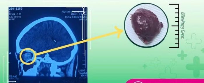 Khối u nằm sâu trong nhãn cầu bệnh nhân được lấy bỏ - Ảnh BVCC