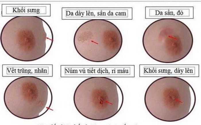 Những dấu hiệu của ung thư vú.