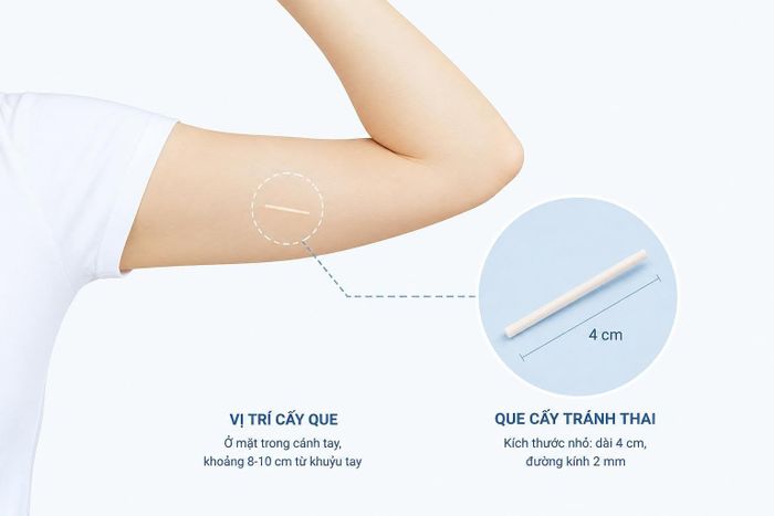 Vị trí que cấy tránh thai sẽ được cấy trên cánh tay (Ảnh: BVCC).