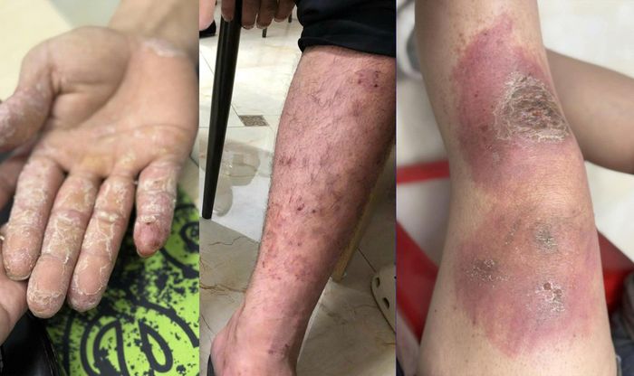 Lội nước ngập nhiều giờ có thể khiến da tổn thương (Ảnh: BSCC)