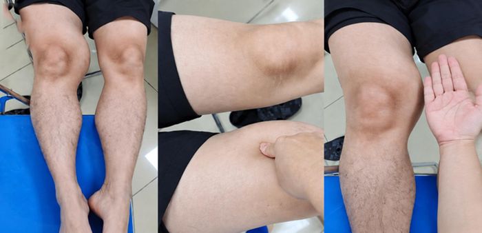 Phát hiện ung thư mô mềm từ khối u bất thường 12cm (Ảnh: BVCC)