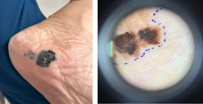 Hình ảnh ung thư tế bào hắc tố trên Dermoscope: màu sắc không đều, bất đối xứng. (Ảnh: Bác sĩ cung cấp)