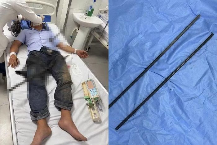 Dị vật là hai thanh sắt được lấy ra từ cơ thể người bệnh. Ảnh: BVCC.