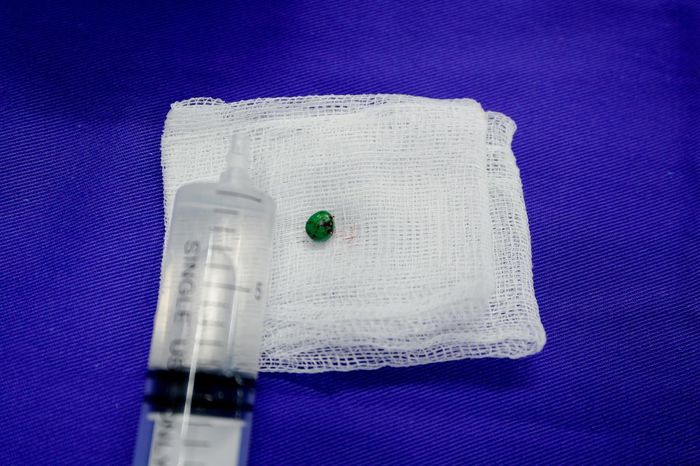 Dị vật sau khi được các bác sĩ lấy ra khỏi tai của bệnh nhi. Ảnh: BVCC