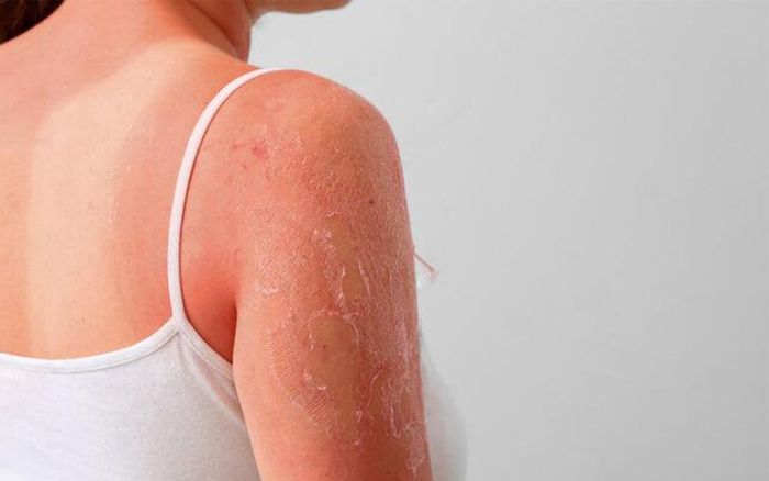 Tia UV gây ảnh hưởng lâu dài đến làn da. Ảnh minh họa