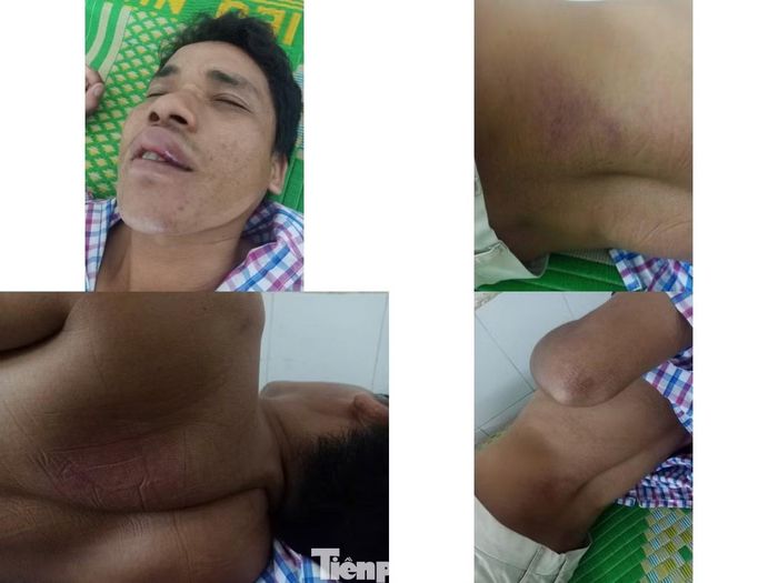 Sau khi bị đánh, anh Đạt rơi vào tình trạng nằm bất động, không còn nhận thức.