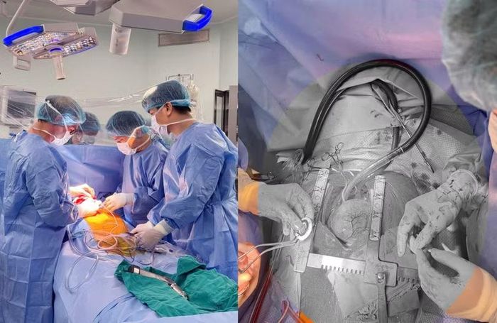 Ca cấy ghép CorHeart 6 đầu tiên tại Việt Nam. Ảnh: Lan Hương.