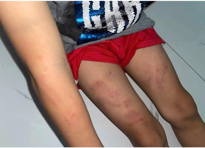 Những vết bầm tím trên cơ thể của bé trai 7 tuổi (Ảnh: N.T.M.T.).
