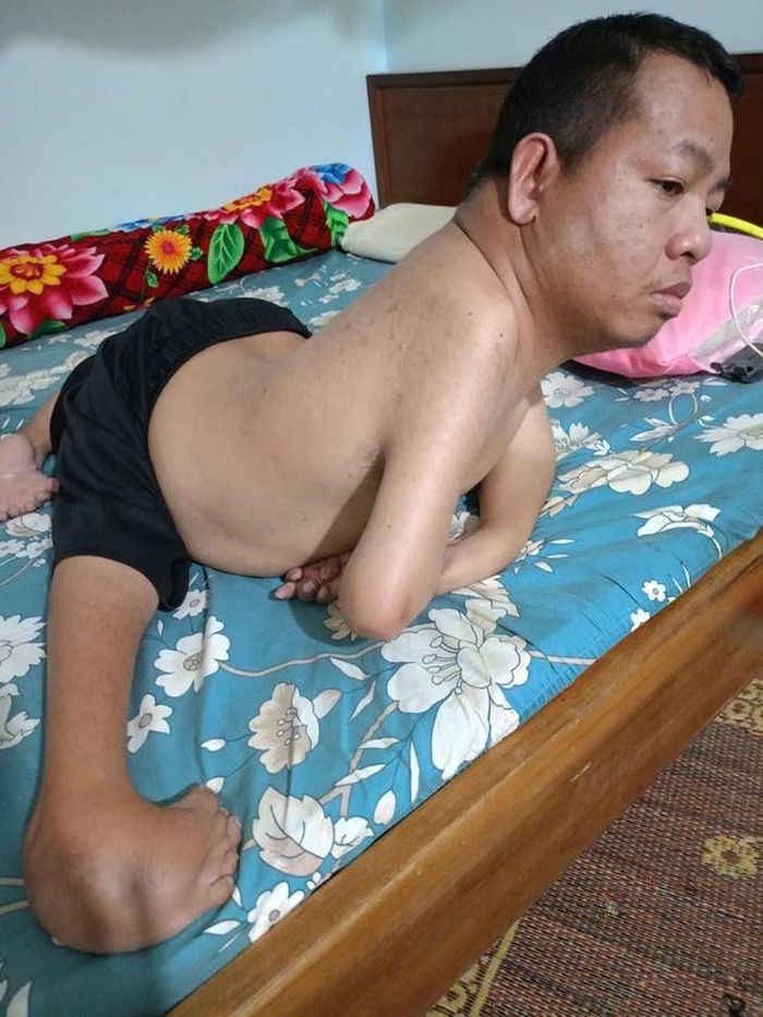Anh Hảo bị dị tật bẩm sinh