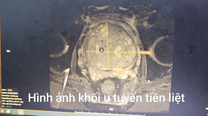 Hình ảnh khối u tuyến tiền liệt của bệnh nhân H. Ảnh BVCC