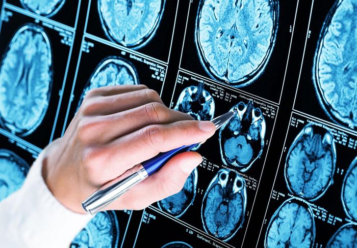 Cấu trúc não bị tàn phá bởi Alzheimer và kháng insulin. Ảnh: Adobe Stock. 