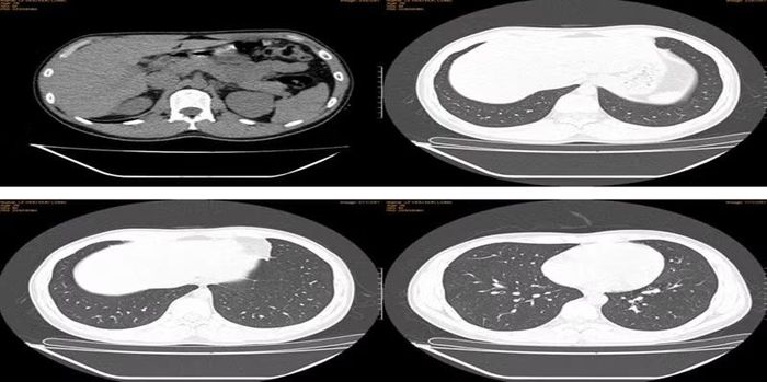 Hình ảnh CT phổi cho thấy thành một số phế quản dày giúp làm rõ tổn thương đường hô hấp và chẩn đoán viêm phế quản. Ảnh BV