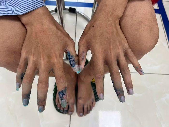 Nhiễm trùng da do ghẻ sau điều trị