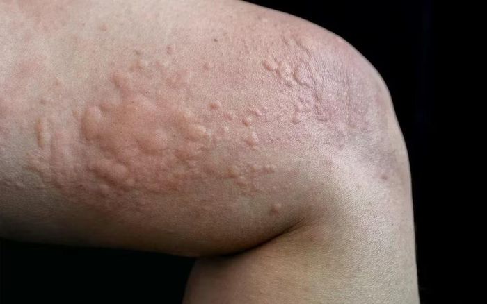 Nếu triệu chứng vẫn chưa được kiểm soát đầy đủ, bác sĩ có thể cân nhắc tăng liều thuốc kháng histamin thế hệ 2, tối đa đến 4 lần liều chuẩn, tùy từng trường hợp và cần được theo dõi đáp ứng lâm sàng. Ảnh minh họa