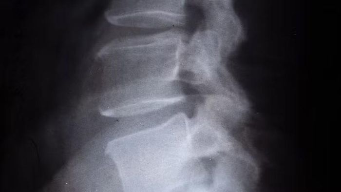 Vật liệu nano mới được phát triển với mục tiêu kích thích cơ thể tái tạo phần xương bị thiếu. Ảnh: Shutterstock.