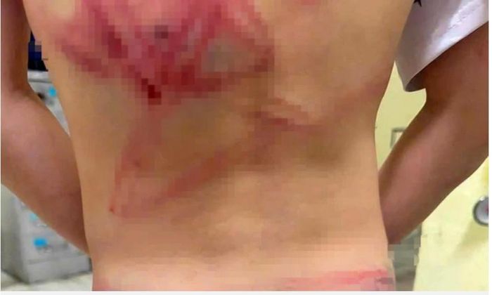 Cháu Đ.Q.B. bị cha ruột đánh với nhiều vết bầm tím trên cơ thể và được gia đình đưa đi viện thăm khám, điều trị. (Ảnh: T.G)