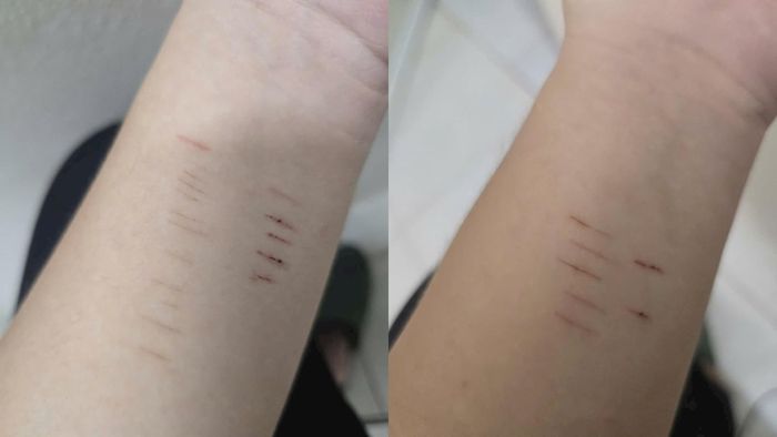 Những thương tổn N.D.T tự gây ra ở hai cổ tay (ảnh nhân vật cung cấp).