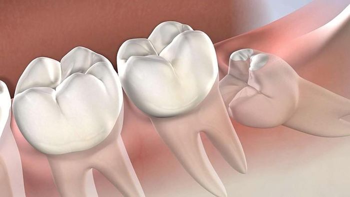 Răng số 8 mọc lệch cần được kiểm tra, đặc biệt khi răng chỉ mọc một phần hoặc khó vệ sinh. Ảnh AI