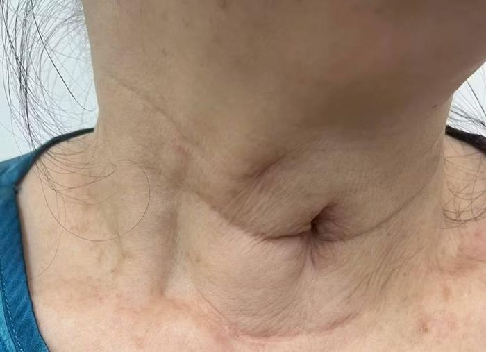 Lỗ mở khí quản lành hẳn, bệnh nhân được rút hoàn toàn canuyn khí quản.