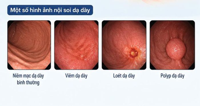 Nội soi đại tràng cũng cho phép phát hiện tổn thương, lấy mẫu sinh thiết và đặc biệt là cắt polyp. Ảnh AI
