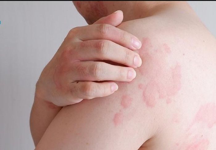 Mề đay là phản ứng của da, đặc trưng bởi các sẩn phù hoặc mảng phù nổi cao trên bề mặt da, thường gây ngứa. Ảnh DK
